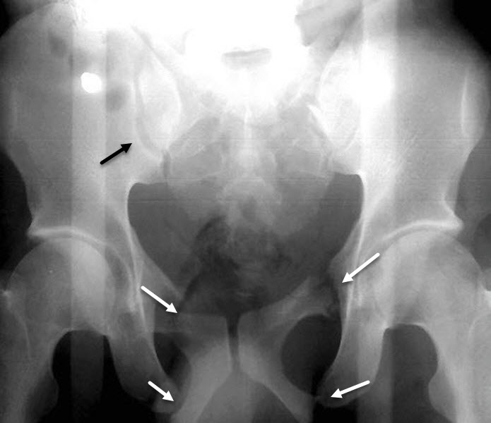 Straddle Fracture, Pelvis.